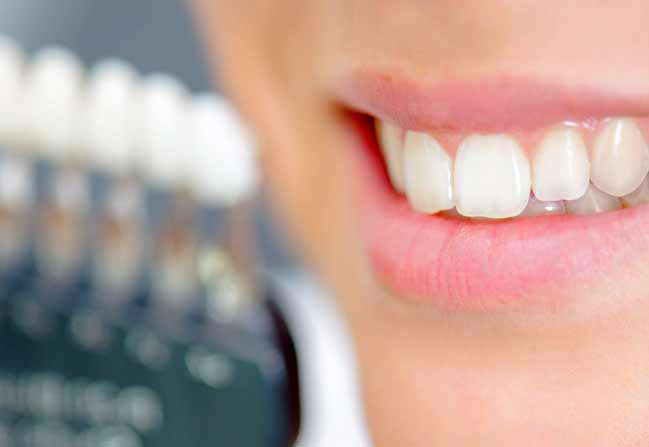 NW Calgary Porcelain Veneers | Scenic Acres Dental Centre | NW Calgary